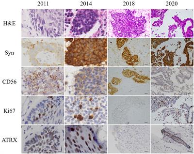 Middle ear neuroendocrine tumor with multiple brain metastases: a case report and literature review